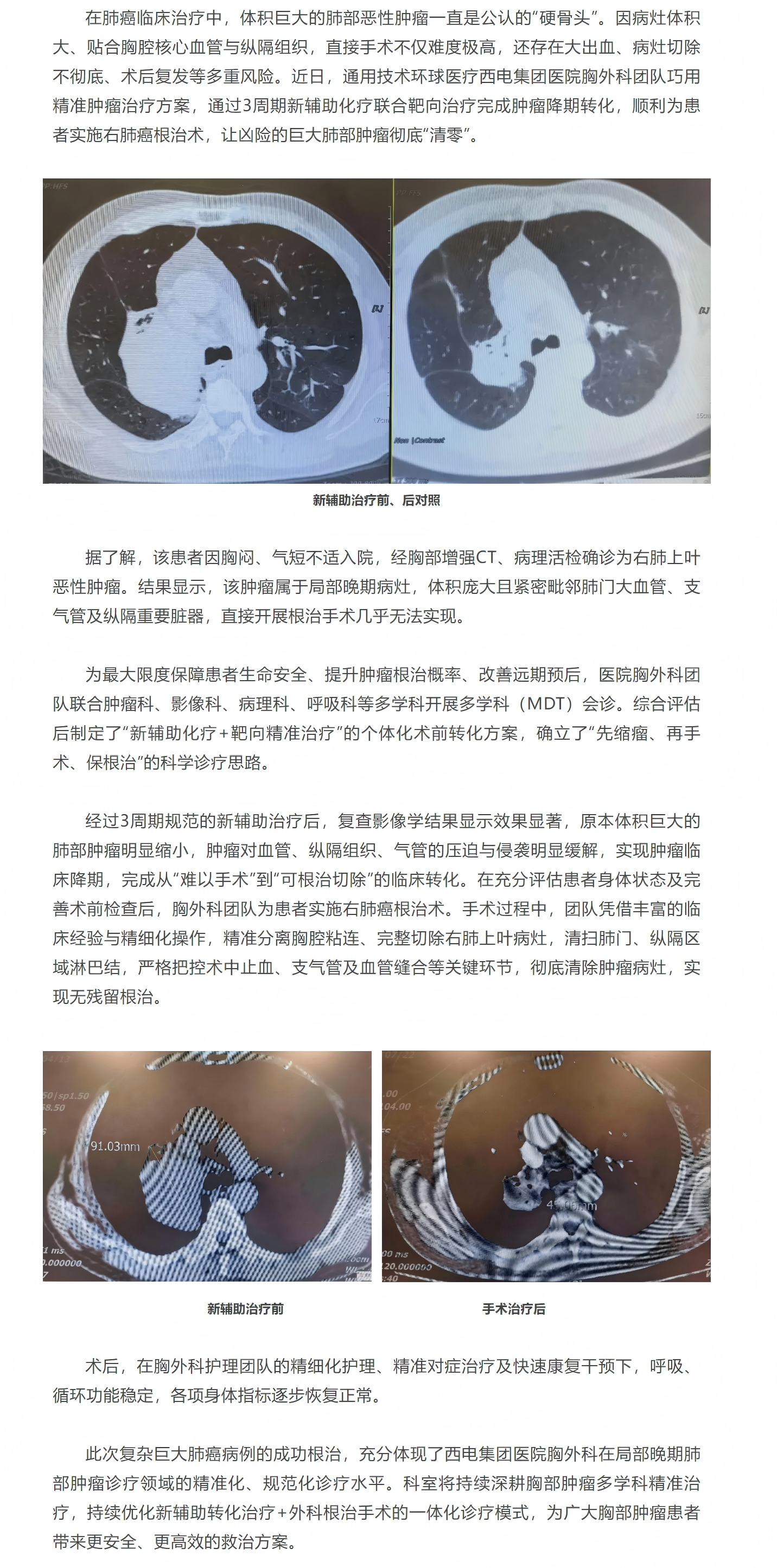 先“精準打壓”再“連根拔除” ！西電集團醫(yī)院胸外科分步闖關(guān)精準除瘤.png